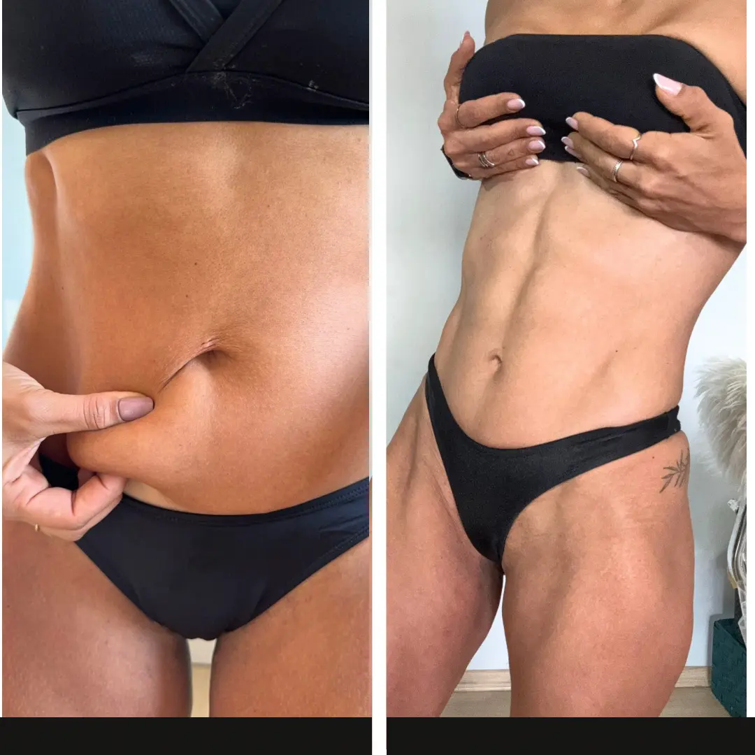 Antes e depois de definição abdominal feminina